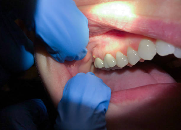 Best Emergency Denture Repair in Yorktown Heights, NY